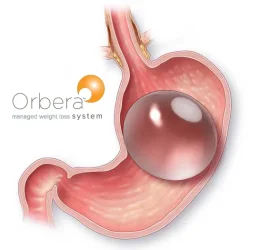 Orbera Weight Loss